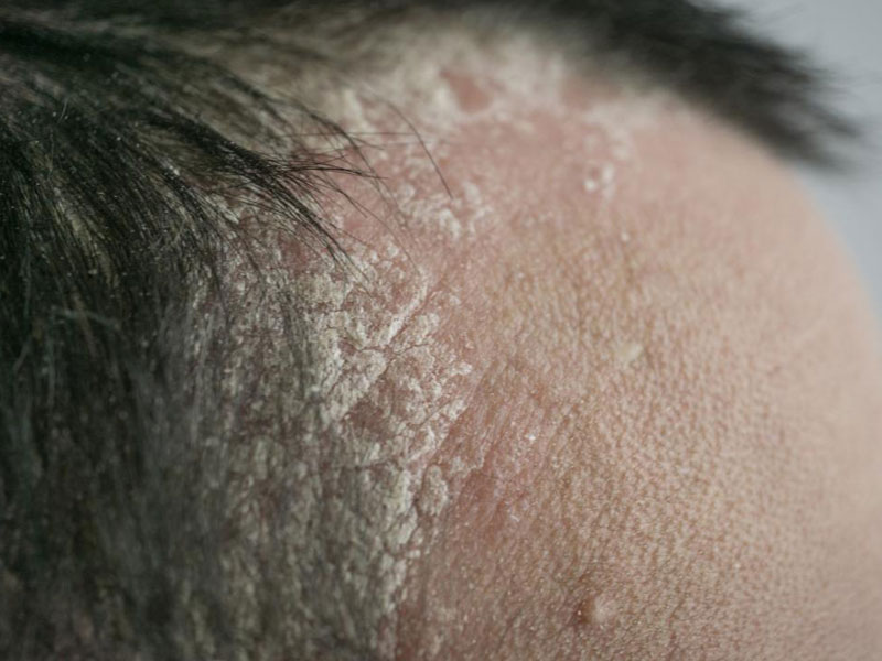 Psoriasis du cuir chevelu